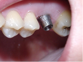 Revisión dental para detectar problemas a tiempo