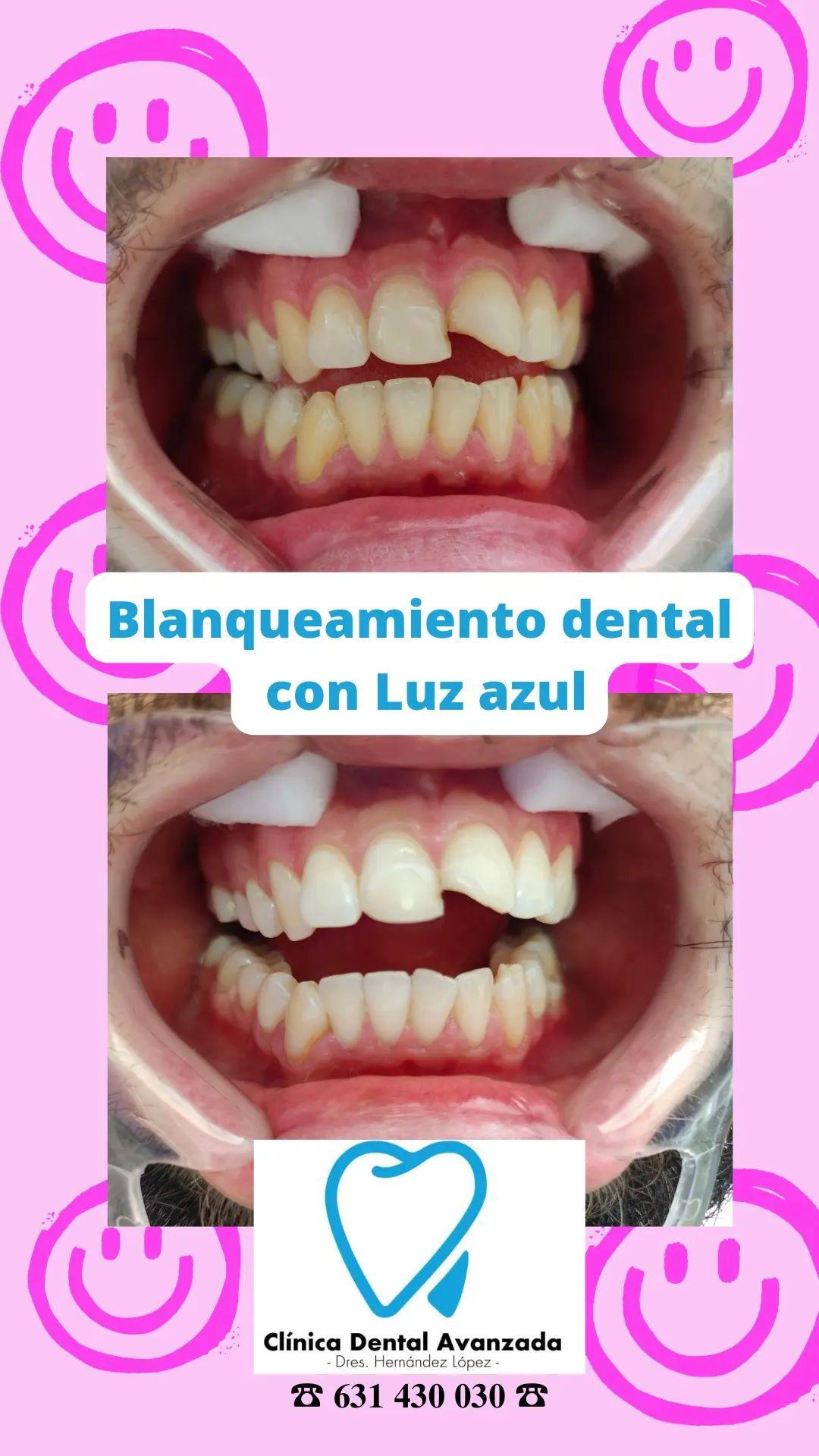 Dientes antes y después de mejorar la estética dental